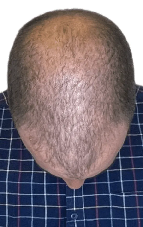 Antes