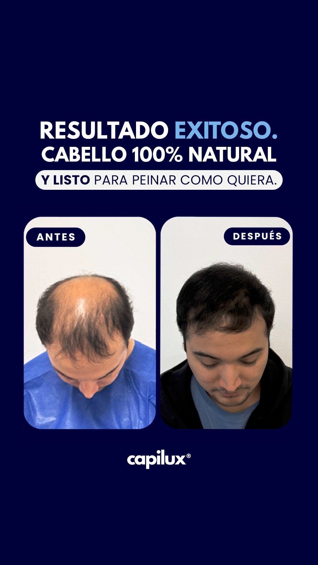 CADA VEZ SON MÁS LOS PACIENTES JÓVENES CON ALOPECIA QUE ACUDEN A NOSOTROS POR UNA SOLUCIÓN DEFINITIVA.